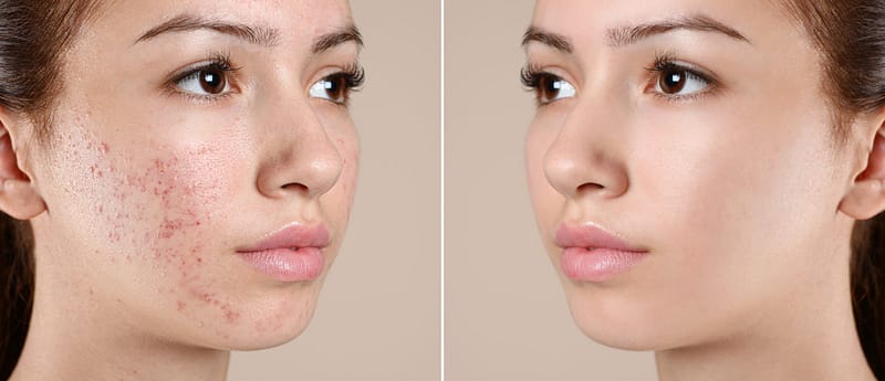 Acne before and after pictures.